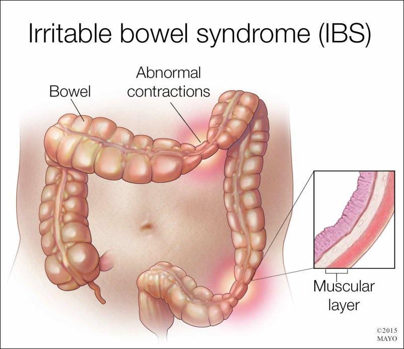 سندرم روده تحریک پذیر یا IBS چیست و تشخیص و درمان آن به چه صورت است؟